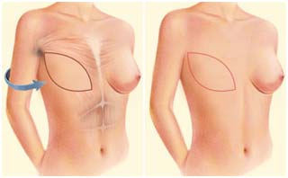 Breast Reduction Surgery, Pune, Cheap Aesthetic Surgery, Low Cost Aesthetic Surgery Services, Cosmetic Surgery India